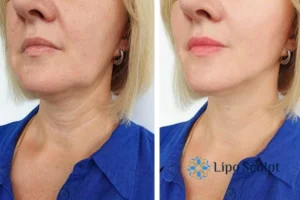 Double chin before and after Hi-Fu treatment 4 Book your double chin treatment Brent today! We are here to help!