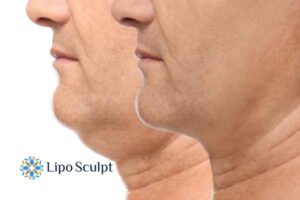 Double chin before and after Hi-Fu treatment 2 Double chin treatment Brent from Lipo Sculpt - feel more confident today!