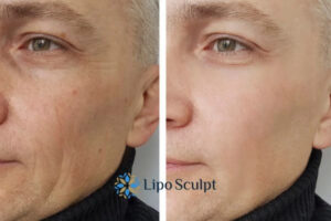How to Fight Aging Symptoms 3 Fight Aging Symptoms Brent With HIFU and Morpheus8 Today!