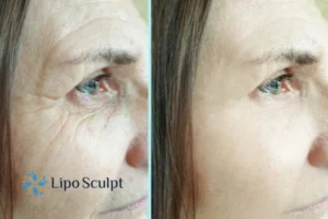 How to Fight Aging Symptoms 2 Do you want to Fight Aging Symptoms Brent? Contact Lipo Sculpt today!