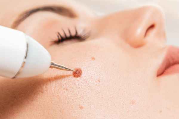 CryoPen: 5 Skin Concerns It May Be Used to Treat 3 What actually happens during a CryoPen treatment Brent?