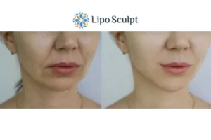 Explaining Total Skin Tightening Treatment And What It Can Do For You 2 Do you want to boost your self confidence? Give Morpheus8 Brent a try today!