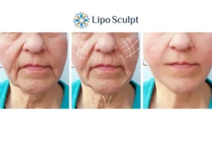 Explaining Total Skin Tightening Treatment And What It Can Do For You 3 Boost your confidence with Morpheus8 Brent call our team today!