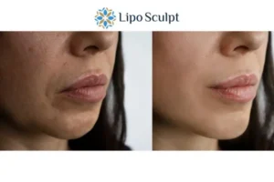 Explaining Total Skin Tightening Treatment And What It Can Do For You 4 Morpheus8 Brent the best results - call our team today!