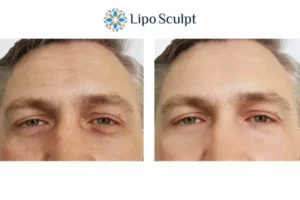 Explaining Total Skin Tightening Treatment And What It Can Do For You 6 Morpheus8 Brent book in today to find out more!